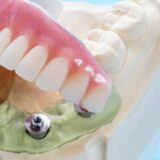 Transform Your Smile with All on Four Dental Implants | Family Dentistry on Brock