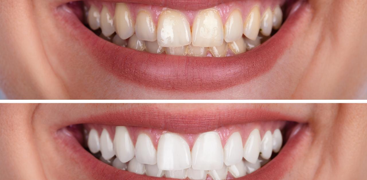celebrity dental implants before and after