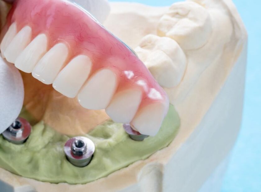 All-on-Four Dental Implants