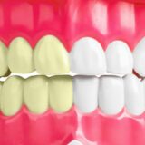 Celebrity Dental Implants Before and After | Family Dentistry on Brock