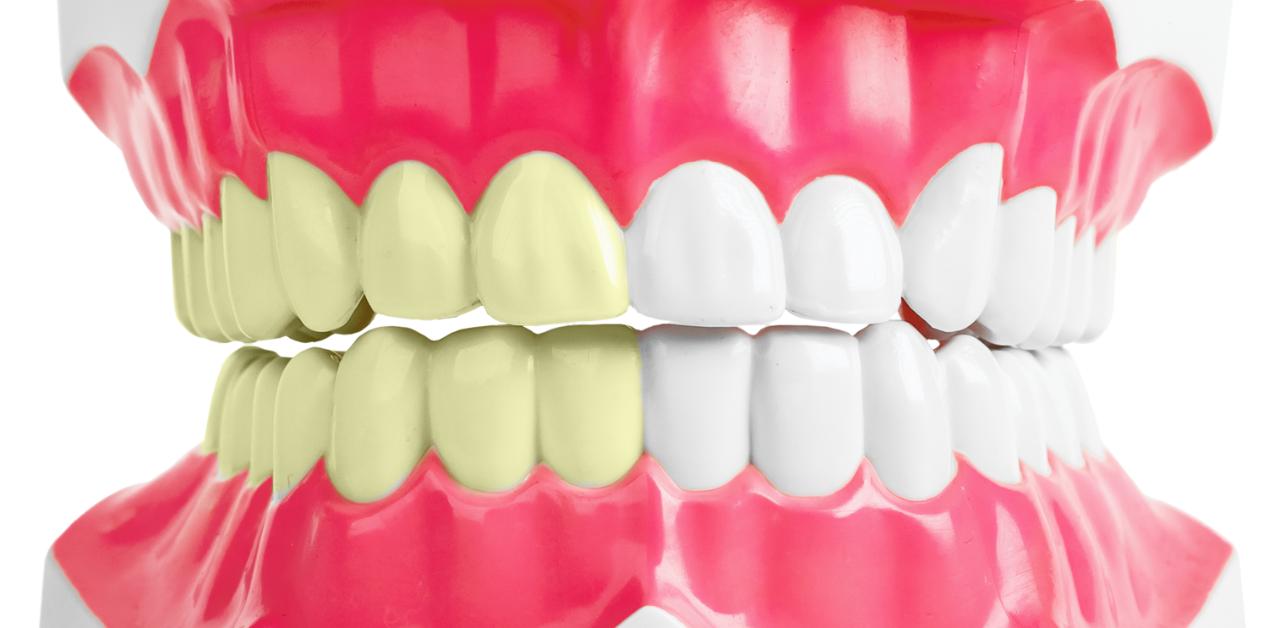 celebrity dental implants before and after