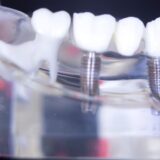 Affordable dentures implant