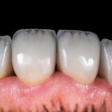 Dental Crown Vs Veneer