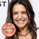 Celebrity Dental Implants before And After