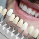 Difference between dental crown and veneer