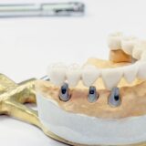 Can you get implants after dentures ?