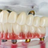 How should lower dentures fit