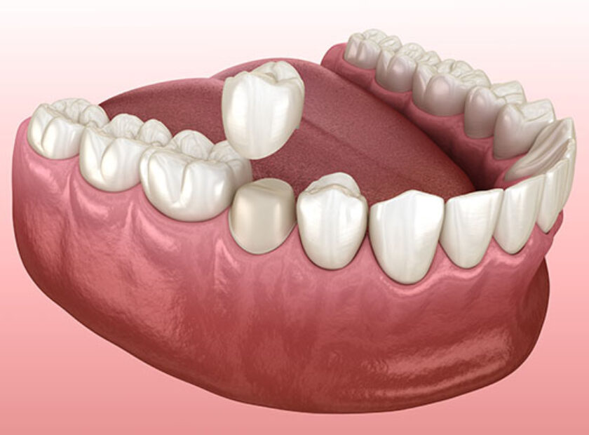 Preparated,Premolar,Tooth,And,Dental,Crown,Placement.,Medically,Accurate,3d