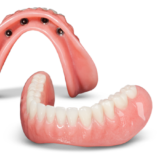 Implant partial denture
