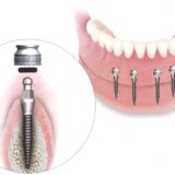 Mini implant dentures