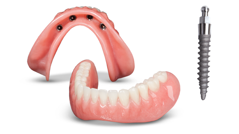 Mini Implant Dentures  
