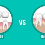 Dental implant versus bridge