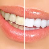 How long will teeth whitening last