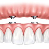 What is a hybrid denture
