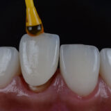 Dental crowns on front teeth