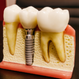Full mouth dental implants