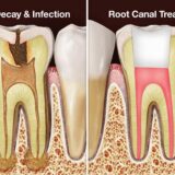 What to expect after a root canal