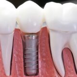 How much will dental implants cost