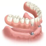 Problems with Snap-in Dentures