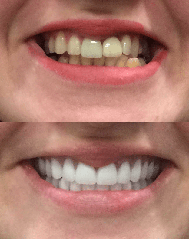 Dentures Images Before After Valplast Flexible Removable Partial Dentures Images Before After Valplast Flexible Removable Partial