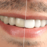 Teeth Whitening Edmonton