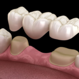 What is a Bridge in Dentistry