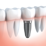 Why No Dairy After Dental Implant