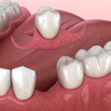 How does a single tooth denture stay in?