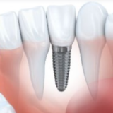 Lower partial dentures bottom front teeth