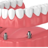 Cost of implant dentures