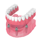 Implant retained dentures