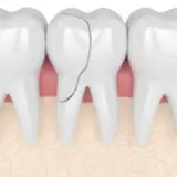 Cracked tooth root canal