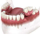What do partial dentures look like?