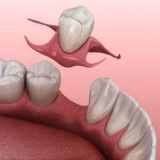 Partial Denture for One Tooth: A Simple Yet Effective Solution