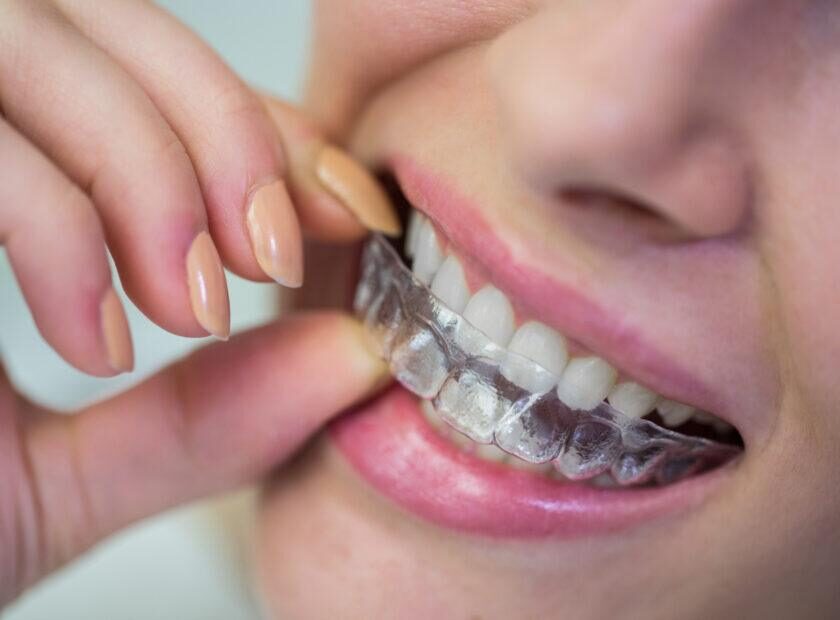 Close-up of woman wearing orthodontic silicone invisible braces