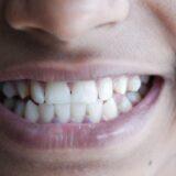Why Are My Teeth Turning Yellow?