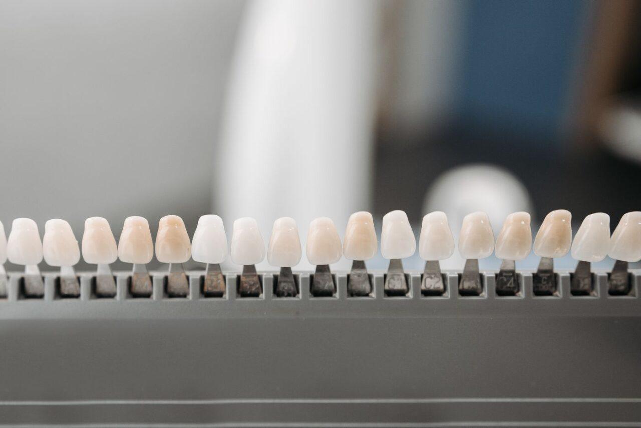 Custom dental veneers prepared for a smile makeover in Tillsonburg