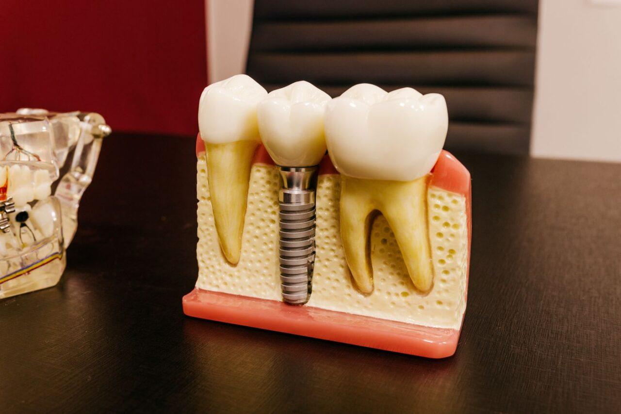 Dental implant post and abutment used for tooth replacement in Tillsonburg
