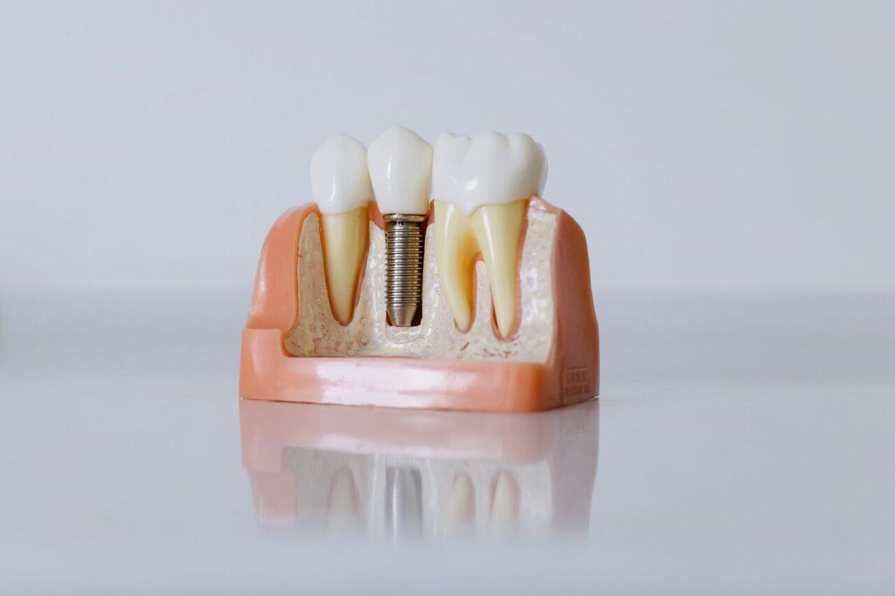 Dental implant and crown model at a dental clinic in Tillsonburg