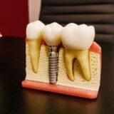 Can You Get Dental Implants If You Grind Your Teeth?