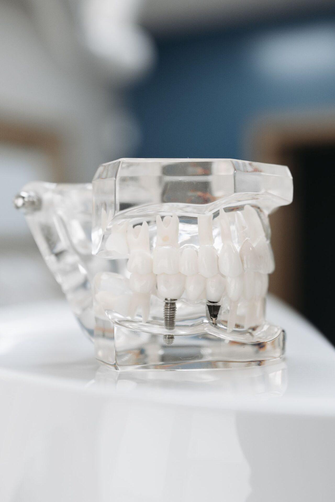 Dental implants in Tillsonburg shown on a transparent jaw model