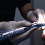 Should You Replace Old Silver Fillings?