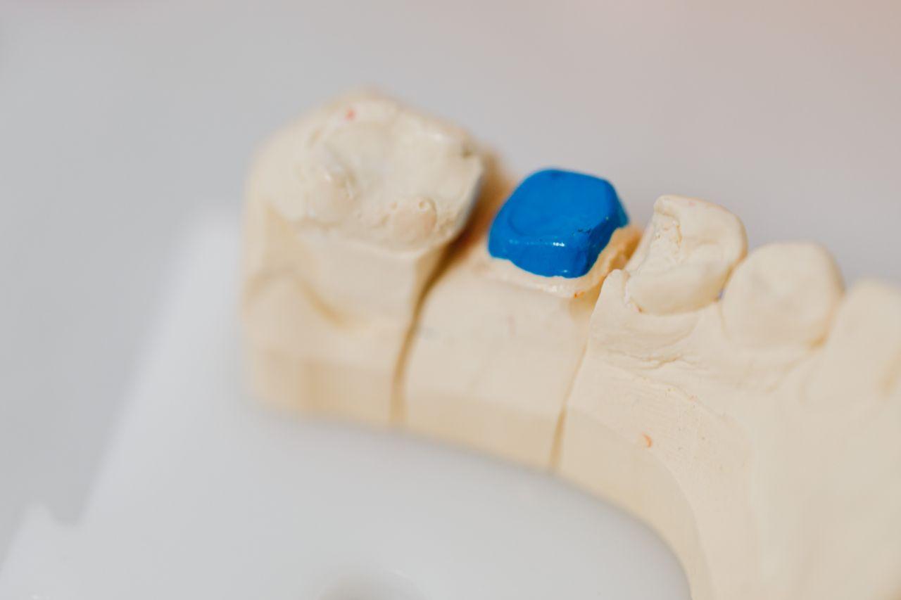 Dental jaw model showing back teeth